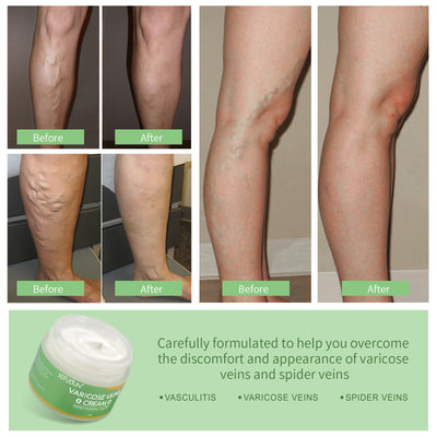 Vein Cream Red Blood Streaks Repair